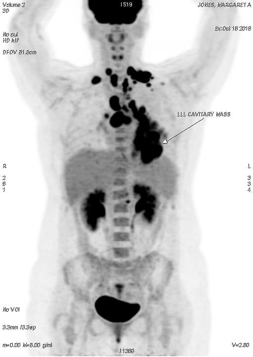 PET-CT summary image front
