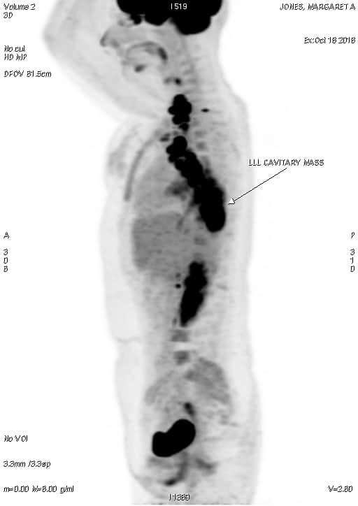 PET-CT Summary image - side
