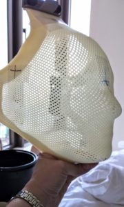 Radiosurgery mask - side