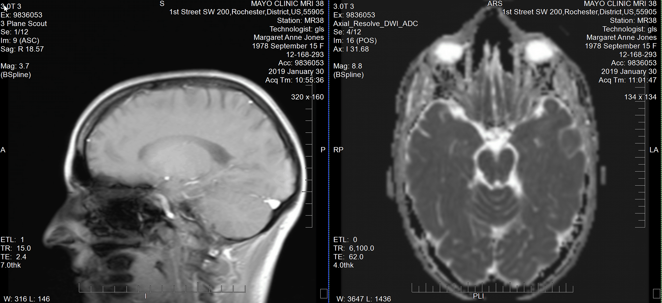 Maggie's Brain MRI
