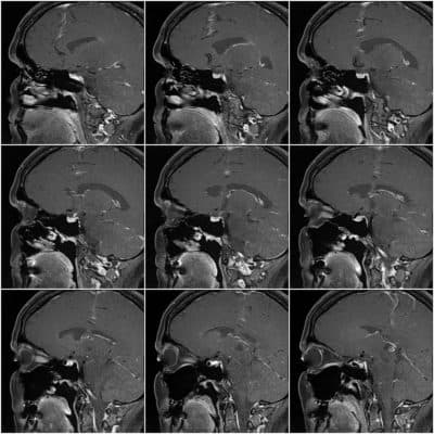 Brain MRI images