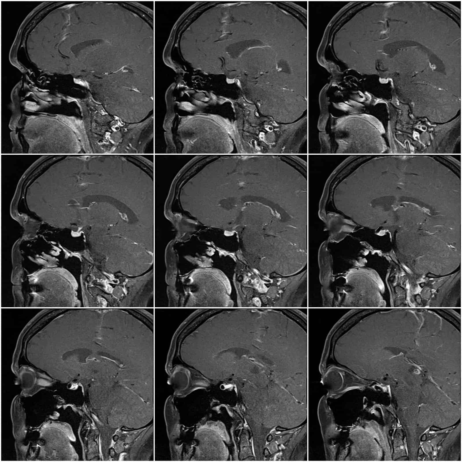 Brain MRI images