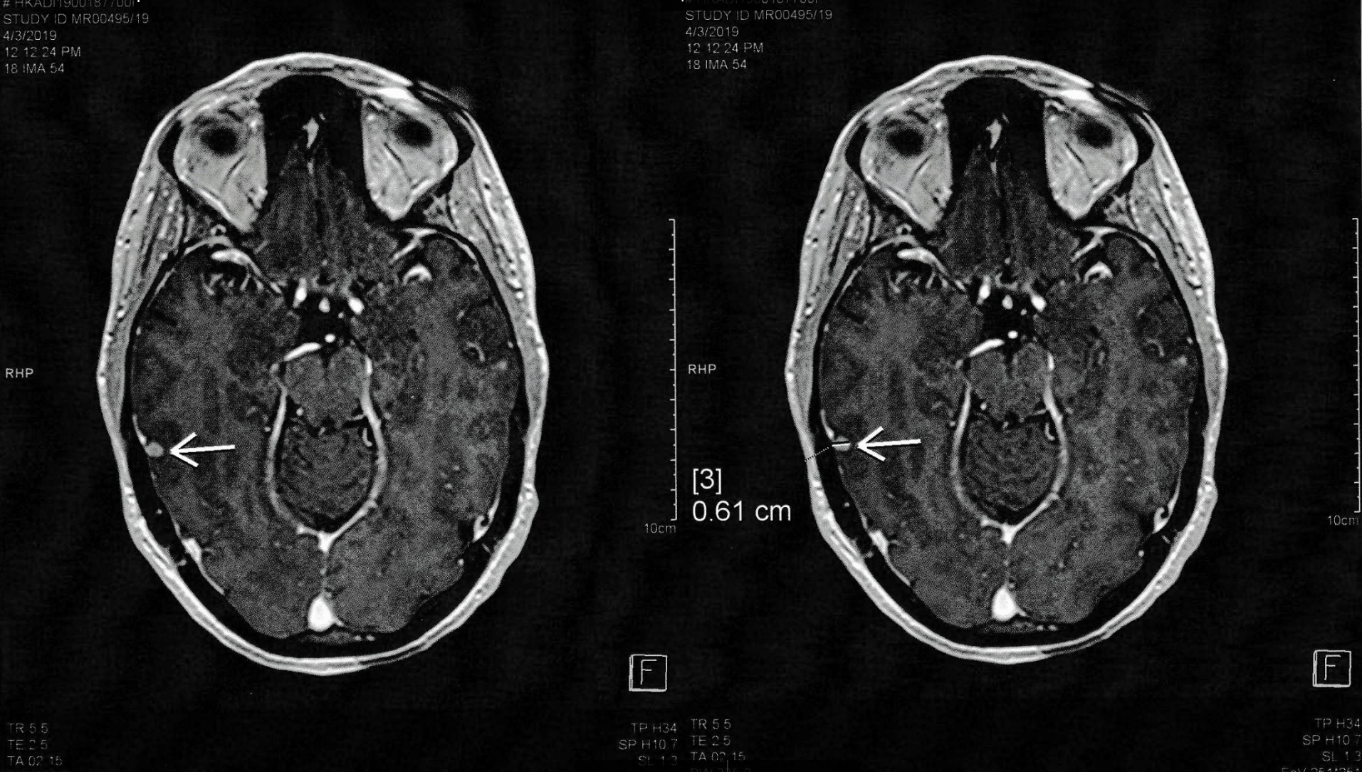 Maggie's New Brain Tumor