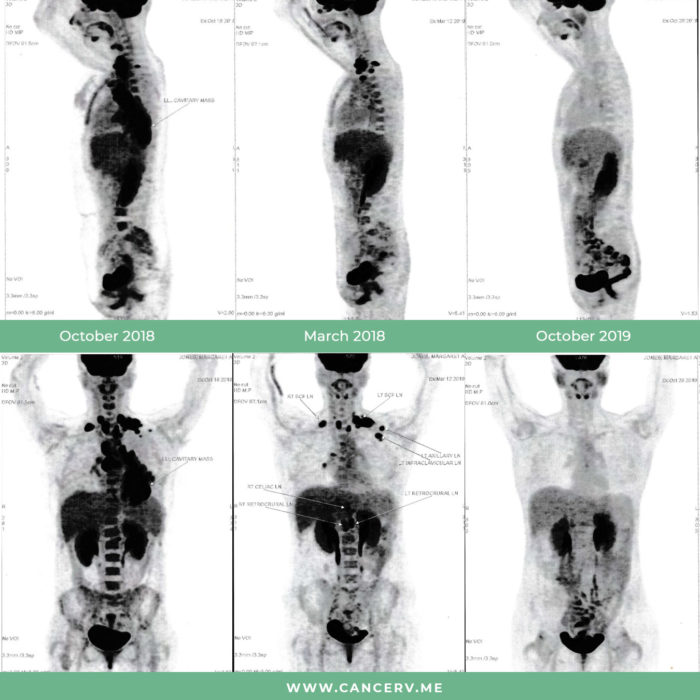 Maggie's PET showing terminal cancer to no evidence of disease in one year