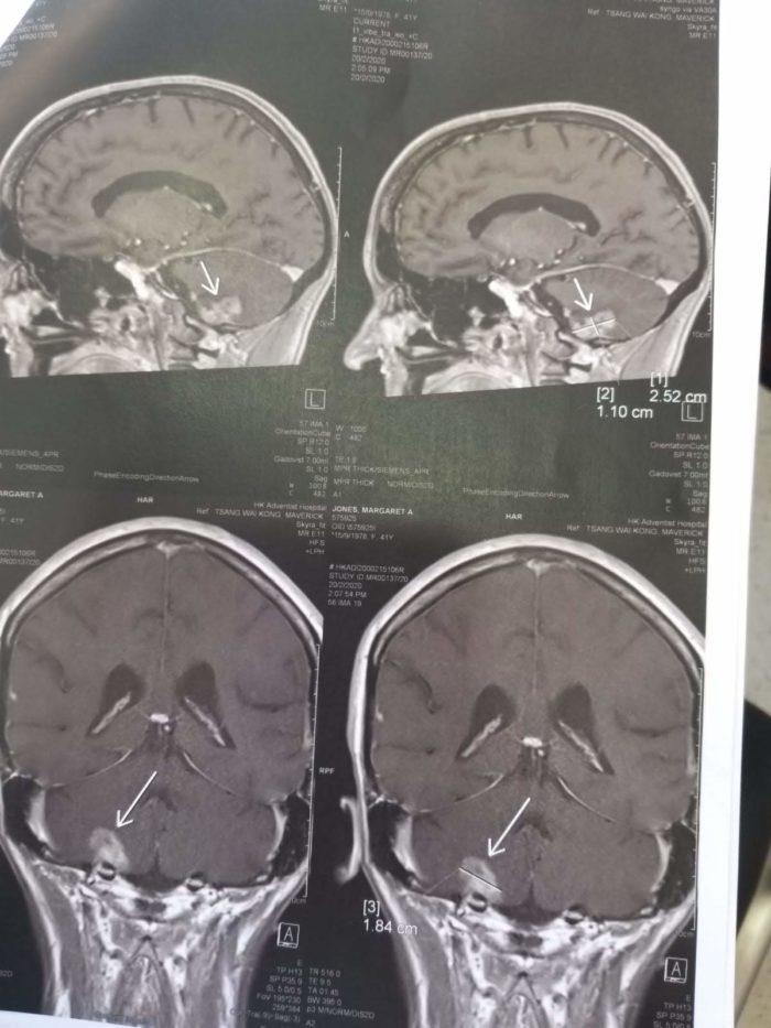 Radiation necrosis or cancer progression? I think it's radiation necrosis.